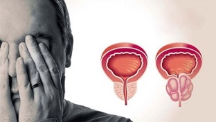 causas da prostatite nos homes